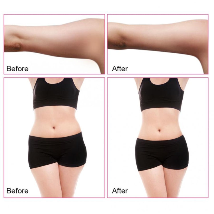 Before-and-after view of treated abdomen and hips with 3-in-1 ultrasonic RF device