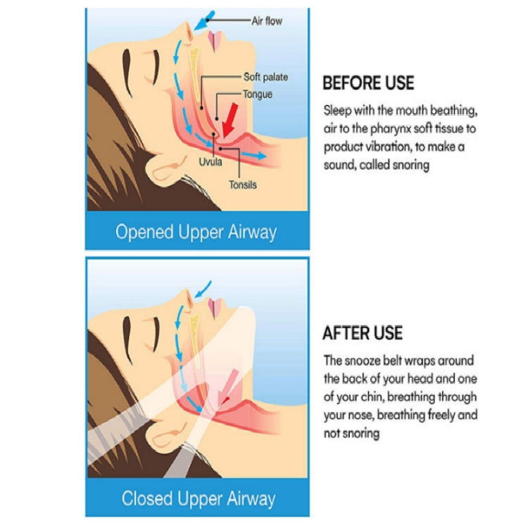 Sleep chin strap diagram showing open vs closed upper airway airflow