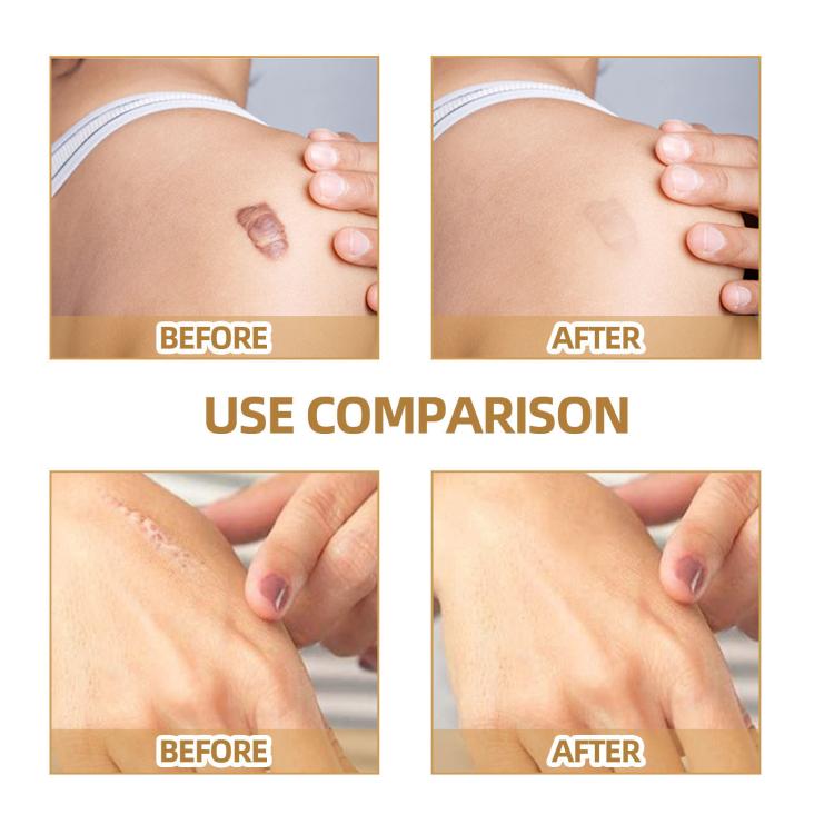 JAYSUING Waterproof Skin Scar Acne Mark Covering Patch, Acne Mark Covering Patch
