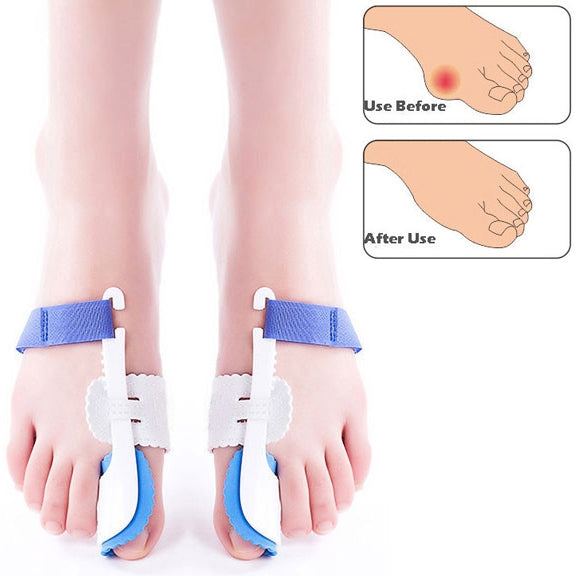 Pair of blue-and-white night bunion splints worn on both feet