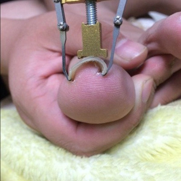 Toe nail care clip tool positioned on a big toenail for ingrown nail treatment
