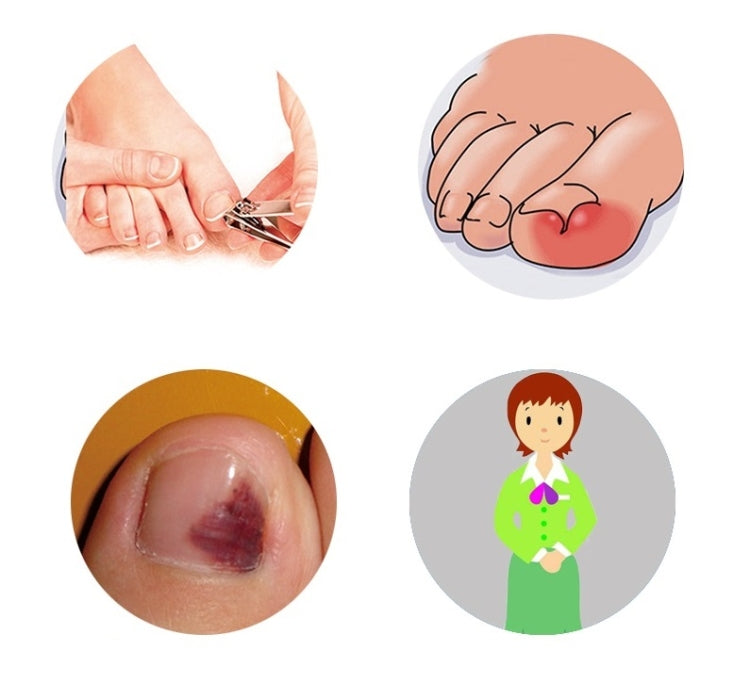 Toenail orthosis spring clip positioned along the toenail edge on a bare toe