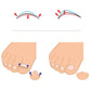 Diagram of toenail orthosis spring wrapping over the toenail for alignment