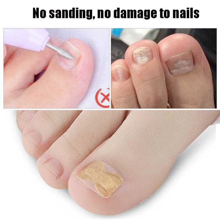 Toe nail correction patch sticker on toenail, beige square patch without tools