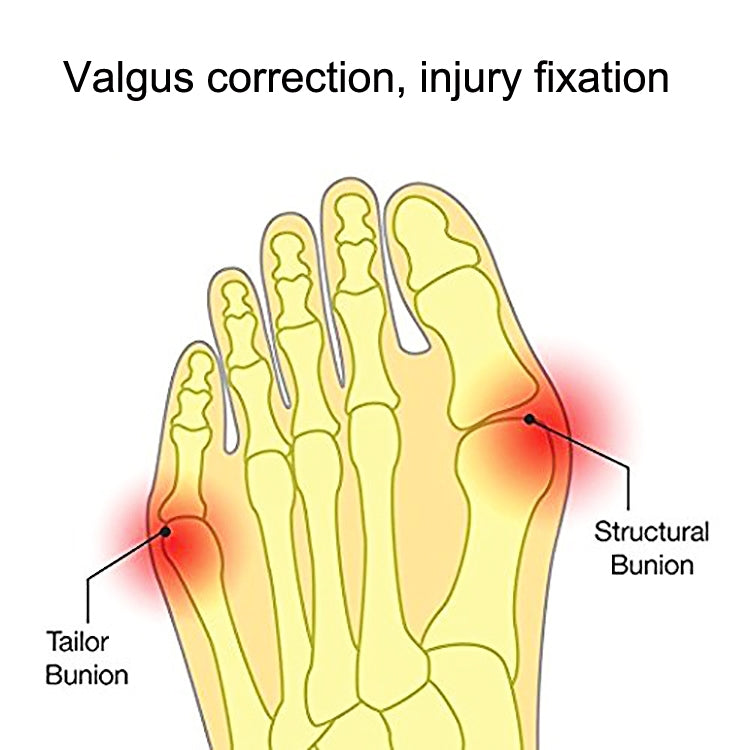 Foot bunion and valgus correction diagram highlighting structural areas